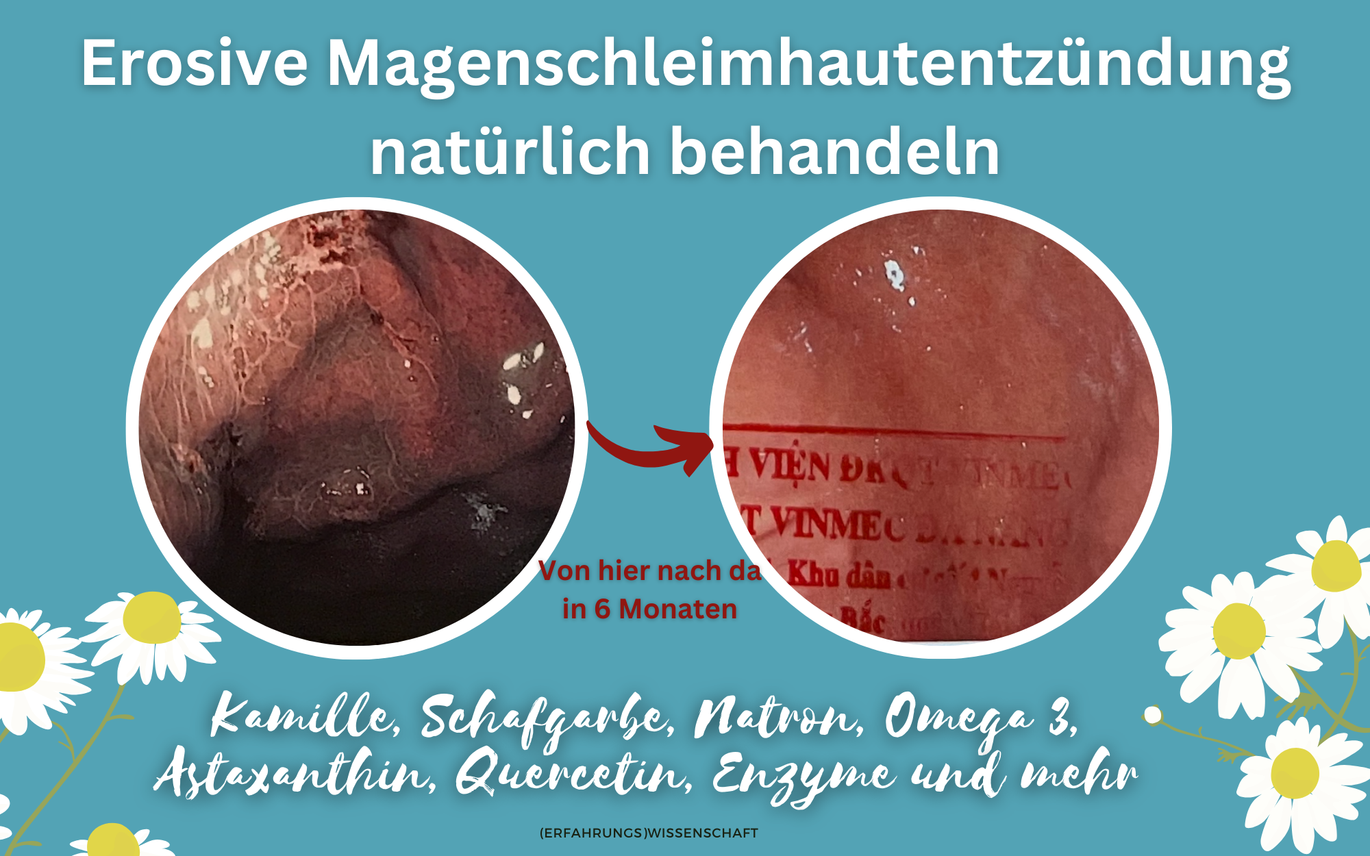 Erosive Gastritis: Arten, Ursachen, natrliche Begleitung